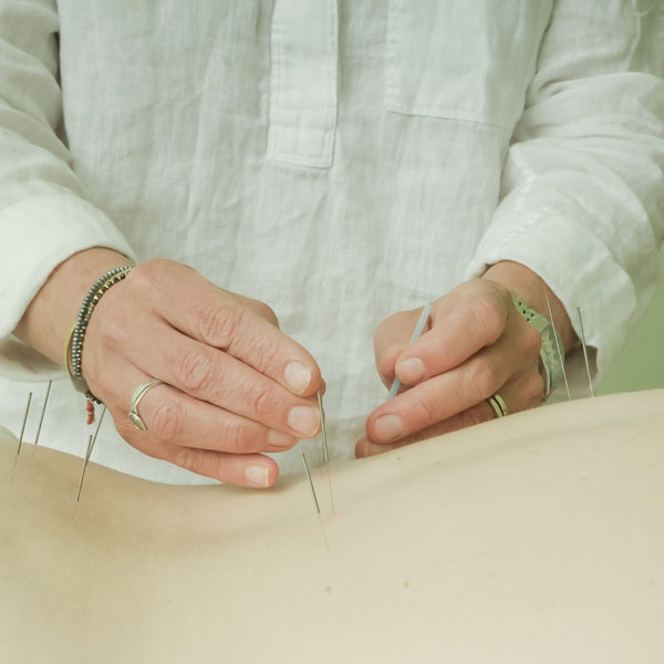 woman receiving acupuncure care needles in back.